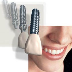 Имплантация зубов - Музенхоф